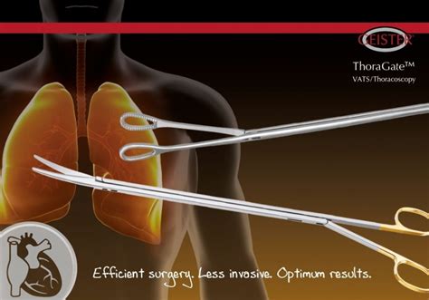 Video Assisted Thoracoscopic Surgery Vats