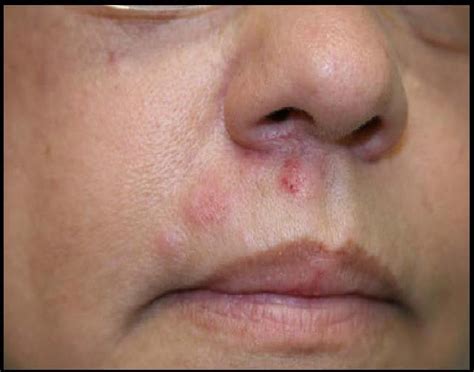 Herpes Rash On Face Pictures Goimages Inc