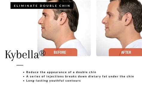 Kybella Lone Tree Double Chin And Non Surgical Fat Removal Denver