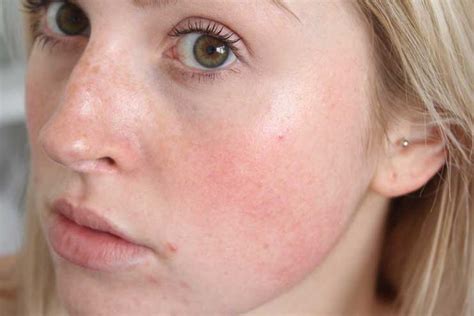Get Rid Of Your Blemishes With These 23 Easy Natural Hacks