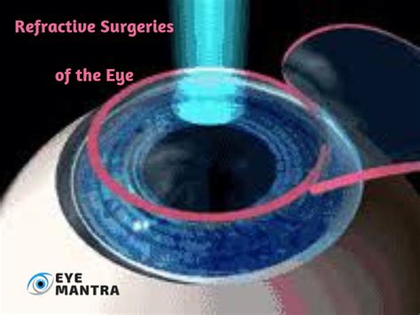 Refractive Surgery Refractive Errors And Types Of Treatment Eyemantra