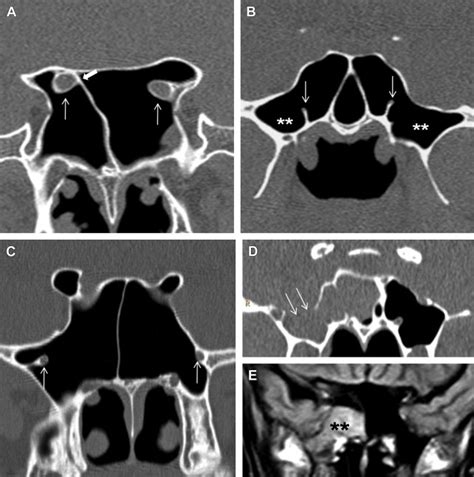 Normal Anatomy And Anatomic Variants Of The Paranasal Sinuses On