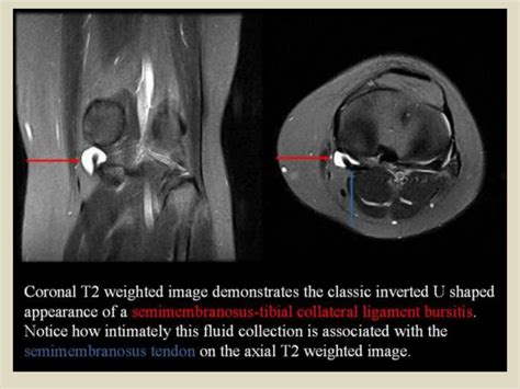 Mri Musculo Skeletal Section Bursa Of Knee Joint