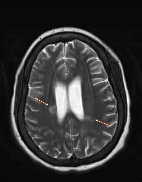 T2 Weighted Magnetic Resonance Imaging Of The Brain Showing Enhanced