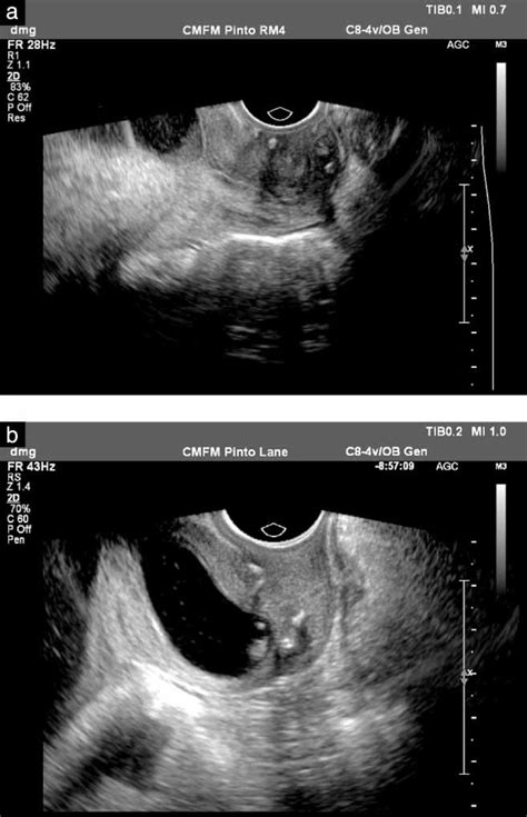 Clinical Implication Of Intra‐amniotic Sludge On Ultrasound In Patients