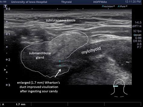 Parotid Gland Ultrasound Measurement