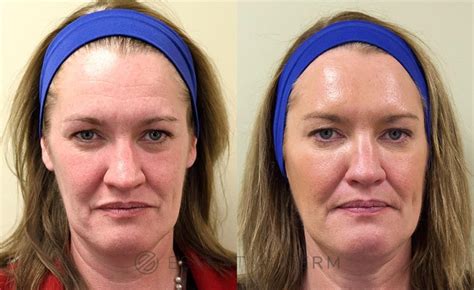 Botox® Cosmetic Before And After Photo Gallery Natick Ma Essential