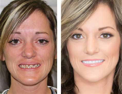 Dental Implant Lp Charleston Oral And Facial Surgery