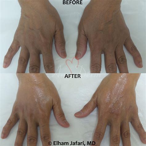 Hand Rejuvenation Cosmetic Treatments Before And After Pictures