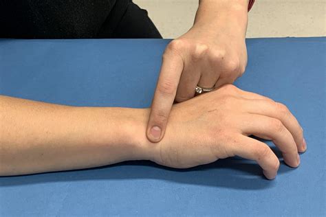 Ulnar Sided Wrist Pain Hand Therapy Group