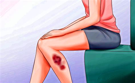 Here Are 6 Health Problems That Will Justify Inexplicable Bruises On Your Body Healthick