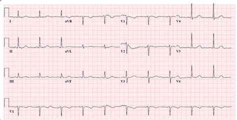 Initial Electrocardiogram Showing A Sinus Rhythm With A Prolonged QTc