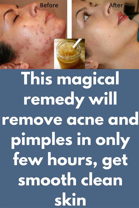 This Magical Remedy Will Remove Acne And Pimples In Only Few Hours Get