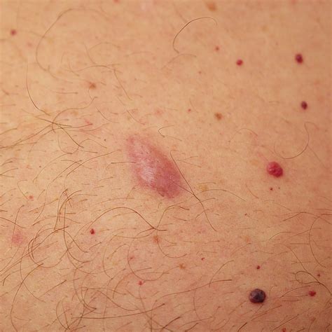 Tiny Black Dots On Skin Pimple On The Hand Causes And Treatment