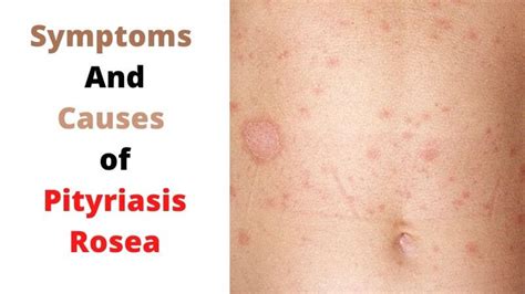 Pityriasis Rosea Foods To Avoid Its Symptoms And Causes The Best Porn