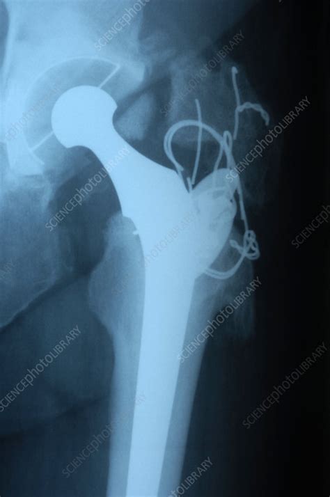 Total Hip Replacement X Ray Stock Image M6000296 Science Photo
