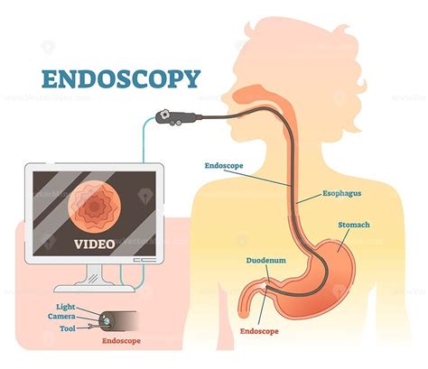 Description Endoscopy Anatomical Vector Illustration Diagram Medical Scheme With Endoscope