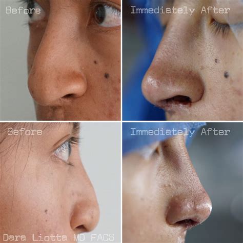 Cleft Lip And Nose 16 Dr Dara Liotta