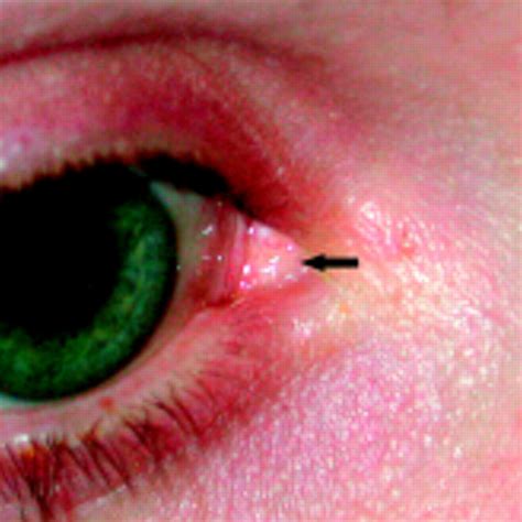 Steatocystoma Simplex Of The Caruncle British Journal Of Ophthalmology