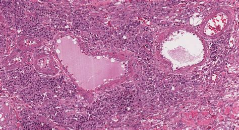 Myeloid Sarcoma Ottawa Atlas Of Pathology