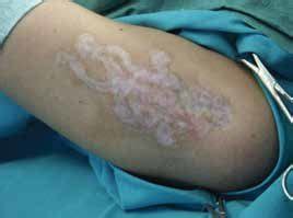If the skin already has irregularities such as scarring expect that to remain after laser tattoo removal. Laser Tattoo Removal Scars Pictures - Tattoo Ideas