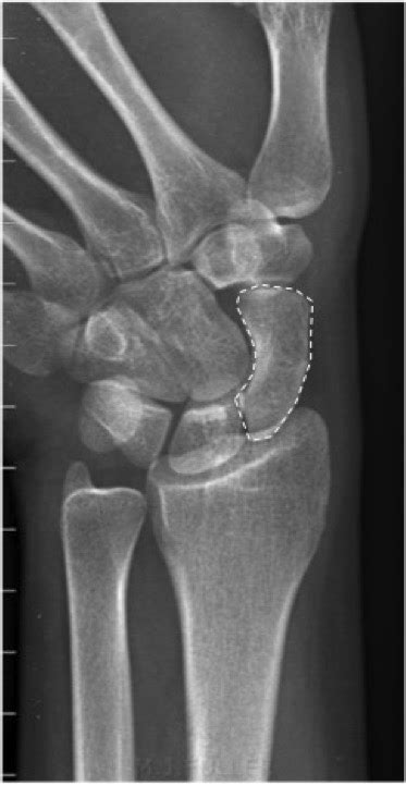 Wrist Trauma Radiographic Evaluation Hand Orthobullets