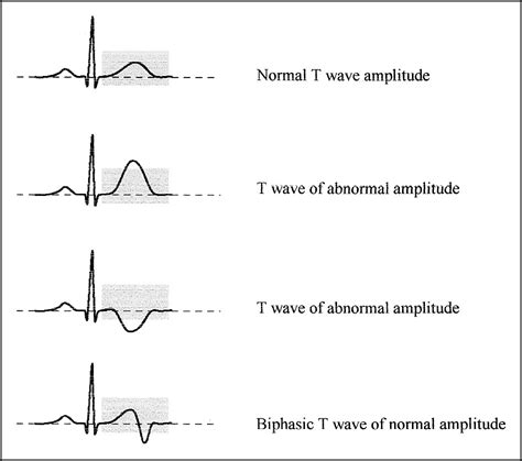 Clinical Significance Of Abnormal T Waves In Patients With Nonst