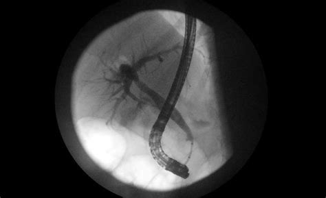 Final Occlusion Cholangiogram After The Second Ercp Showing Duct Clear