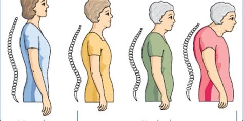 Dowager's hump is a forward bending of the spine. Treating Dowager's Hump - Geneva IL Chiropractor
