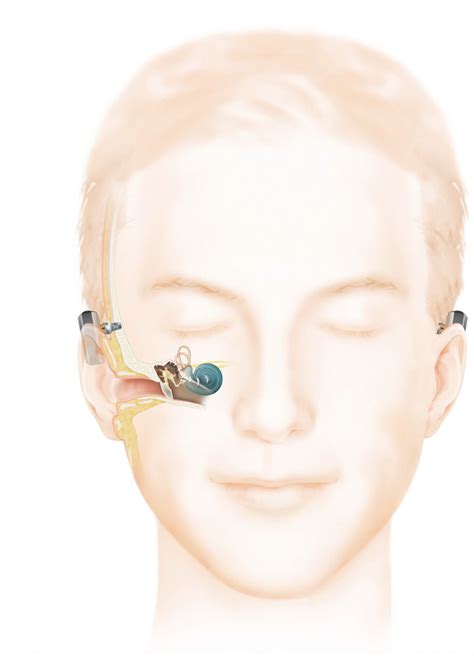 Baha Bone Anchored Hearing Aids At Link Audiology