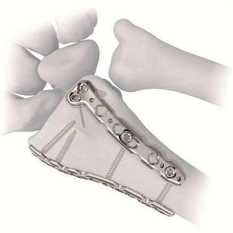 24mm Variable Angle Lcp® Dorsal Distal Radius Plate Welcome To Sys