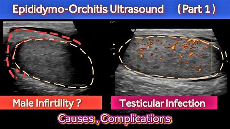 Acute Epididymo Orchitis Ultrasound Male Infertility Causes