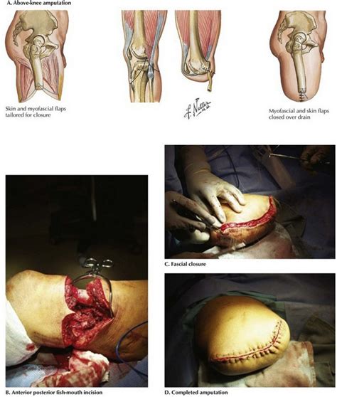 Above Knee And Below Knee Amputation Basicmedical Key