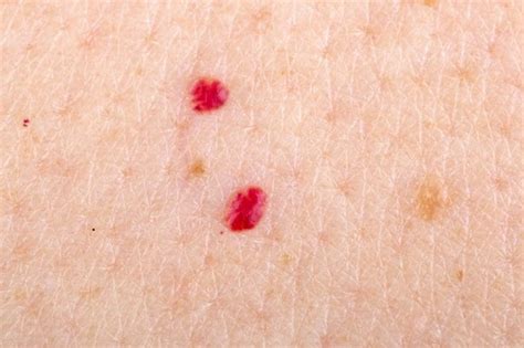 Vascular Lesions And Cherry Angiomas Causes And Treatments Revival Medi Spa