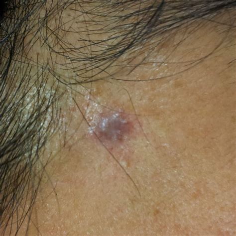 What causes campbell de morgan spots or blood spots? Campbell de Morgan | Large Blood Spot Removal with Diathermy