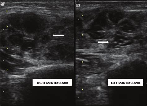 Ultrasonogram Of The Right And Left Parotid Gland Of A Patient With
