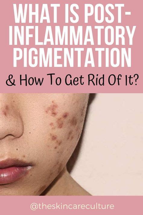 What Is Post Inflammatory Pigmentation And How To Get Rid Of It With