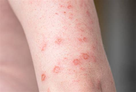 Syphilis Rash Stock Photos Pictures And Royalty Free Images Istock