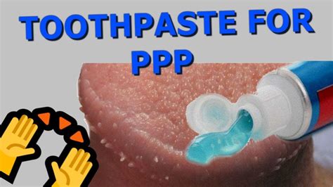 Pearly Penile Papules Removal With Toothpaste Youtube