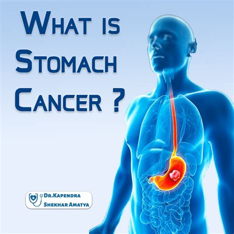 Stomach Cancer Dr Kapendra Shekhar Amatya