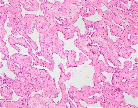 Pathology Outlines Hemangioma