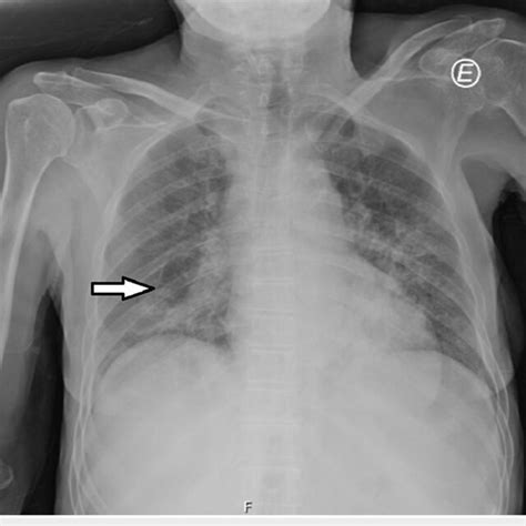 Chest Radiograph At Admission Showing A Diffuse Bilateral