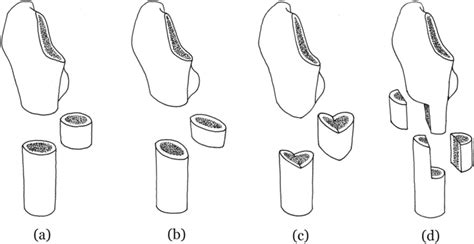 Schematic Illustration Of Different Methods Of Subtrochanteric Femoral