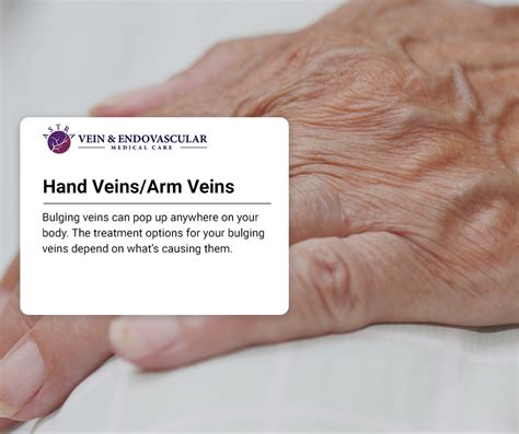 Hand Veinsarm Veins Vein And Endovascular Medical Care