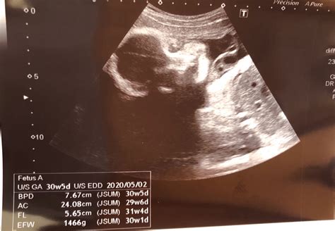 【双子】妊婦検診32週目の成長結果 Otodanblog