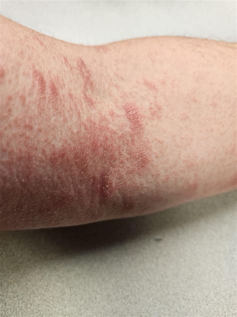 Pityriasis Rosea Or Tinea Versicolor Rdermatologyquestions