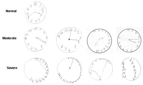 'the clock face must be a circle with only minor distortion acceptable (e.g. Clock drawing cognitive test should be done routinely in patients with high blood pressure