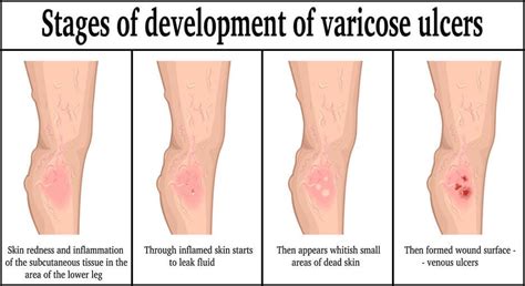 Venous Insufficiency Leg Ulcers Center For Advanced Cardiac And
