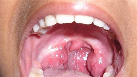 Tonsil Cancer Causes Symptoms Prognosis And Treatment Woms