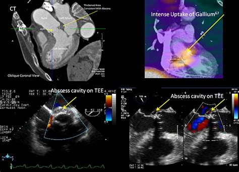 Aortic Root Abscess Multimodality Imaging With Computed Tomography And
